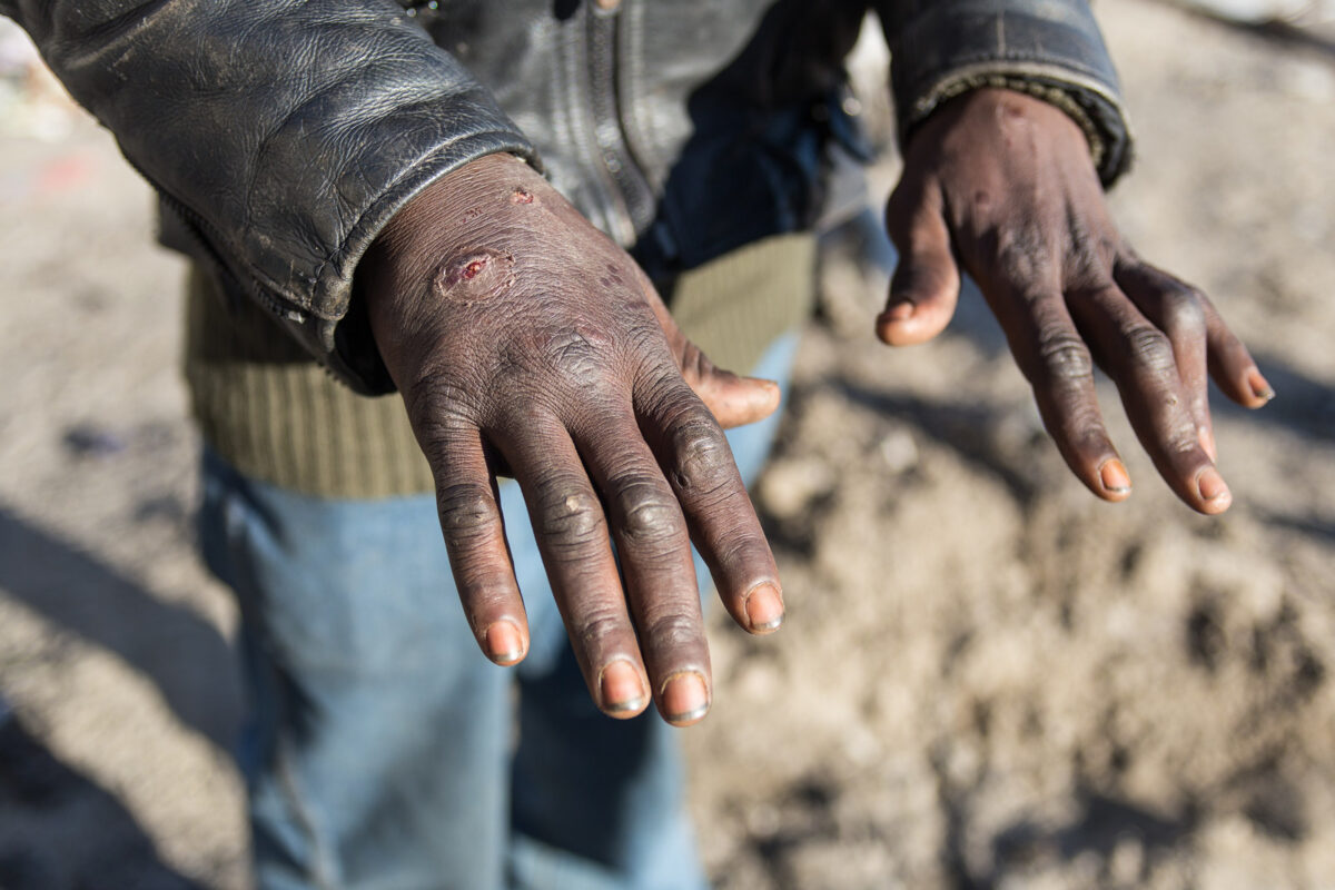 Μετανάστες στο Καλαί καταγγέλλουν αστυνομική βία