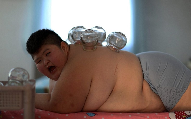 Βεντούζες, βελονισμός και φωτιά για απώλεια βάρους