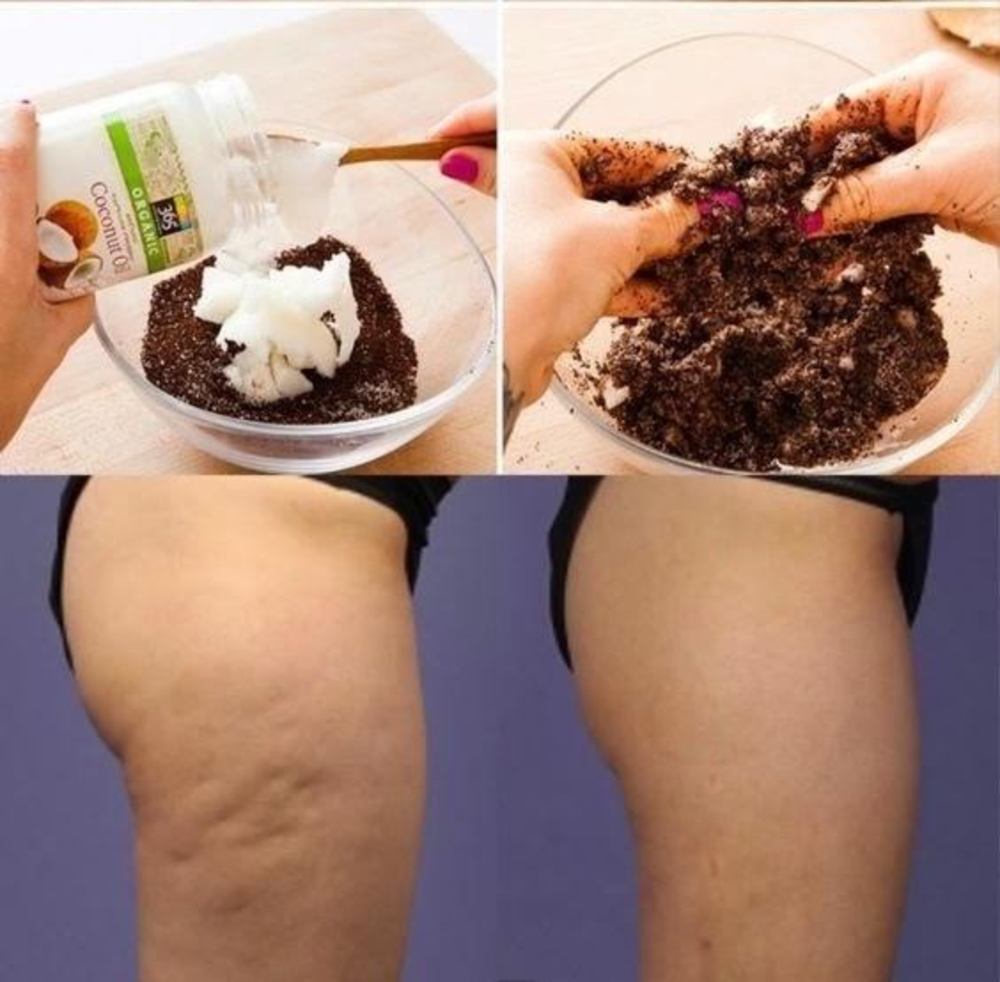 H σπιτική συνταγή που καταπολεμά την κυτταρίτιδα