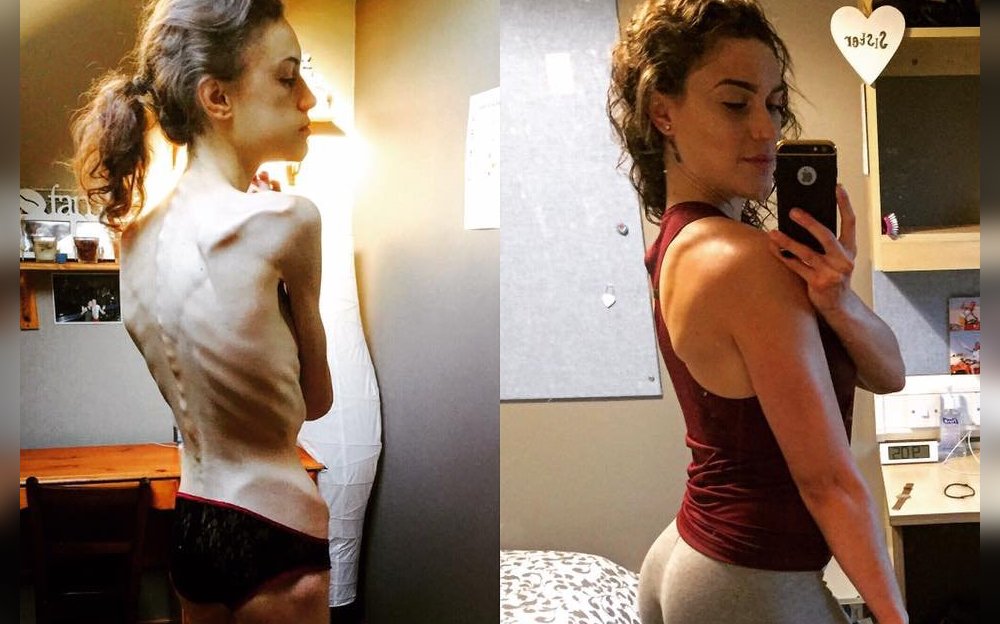 Emelle Lewis | H ιστορία της 22χρονης που έφτασε να ζυγίζει 30 κιλά εξαιτίας της anorexia nervosa