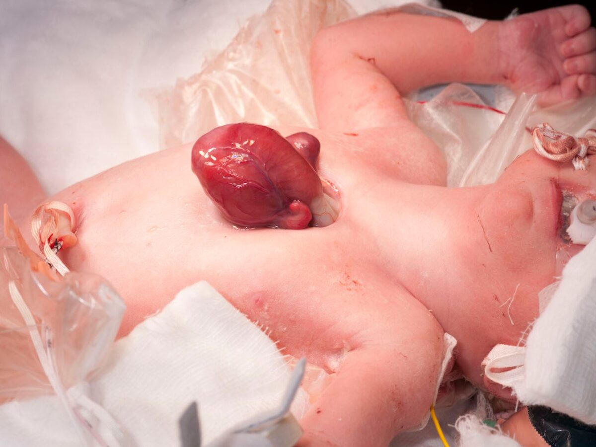 Με συγκλόνισε η  ιστορία του μωρού που γεννήθηκε με την καρδούλα του έξω από το σώμα του