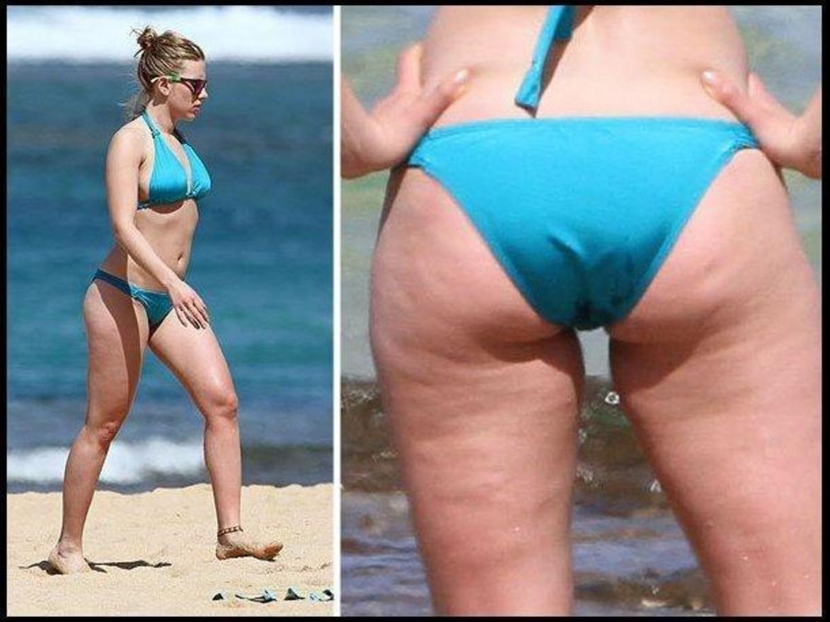 Κυτταρίτιδα | 4 ιδανικοί τρόποι αντιμετώπισης του αιώνιου εχθρού που έχουν ακόμα και οι σταρ...