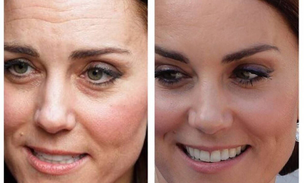 Θρίλερ με το πριγκιπικό… botox! (ΦΩΤΟ)