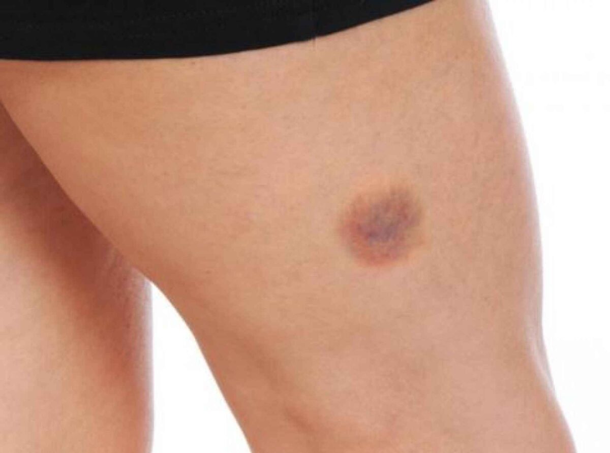 Τα «μαγικά» της φύσης! Γιατί μια μελανιά αλλάζει συνεχώς χρώμα;