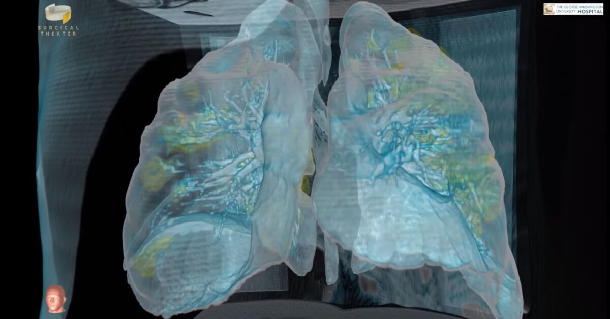 Συγκλονιστικό! Δείτε τι κάνει ο κορωνοϊός στους πνεύμονες (Βίντεο)