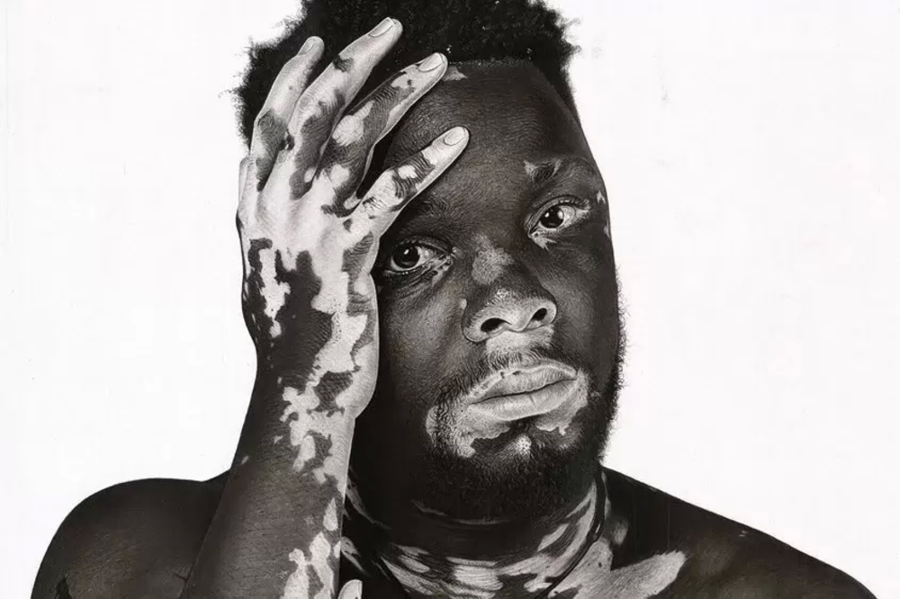 Martin Senkubuge | Πώς ο καλλιτέχνης επηρεάστηκε από την πάθηση του Michael Jackson & άρχισε να καταπολεμά το στίγμα της λεύκης